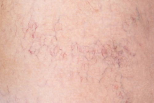 Escleroterapia de telangiectasias CDMX
